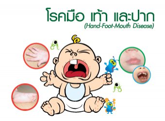 What kind of symptoms are called hand-foot-mouth disease?